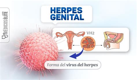 si mi pareja y yo tenemos herpes podemos tener relaciones|Herpes genital: qué es y cuándo puede retomarse el。